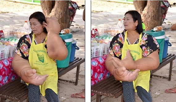泰国女子的畸形巨手  让她生活痛苦不堪  自卑心让她没敢去上学