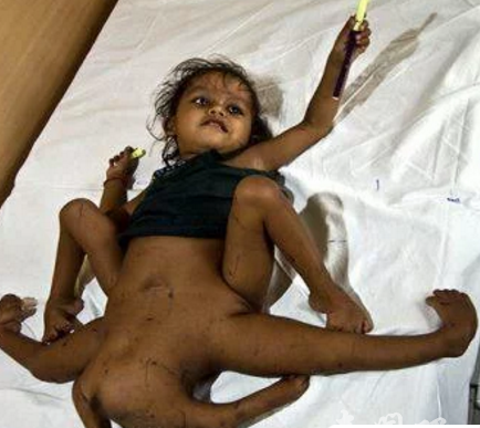 印度现实版“极品小女神”！奇葩女神刚出生就长了四只手和四条腿，百年难遇的怪胎