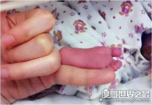 世界上最小的婴儿阿米利娅·泰勒，仅280克现在依然健康