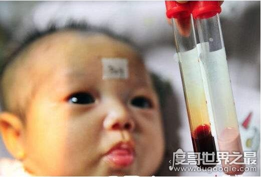 世界上最奇特的血液，河南新生儿拥有粉红血液(是遗传代谢病)