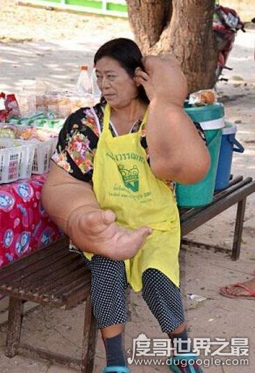 世界上最大最粗的手，泰国女子患巨臂症手臂比腰还粗(组图)