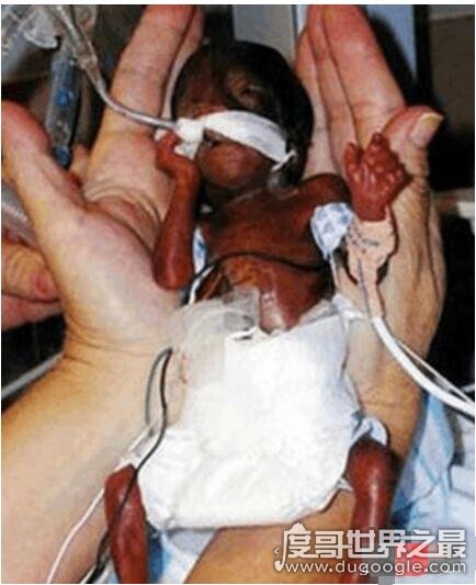 世界上最小的婴儿，阿米利娅·泰勒(仅重280克/长24厘米)