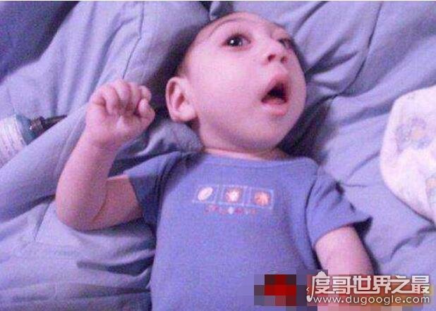 奇迹宝宝尼古拉斯·柯克，世界上首个活过了3年的无脑儿