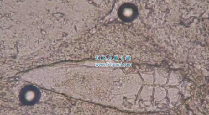 男子睫毛里爬出3条虫 用眼卫生有哪些小知识?