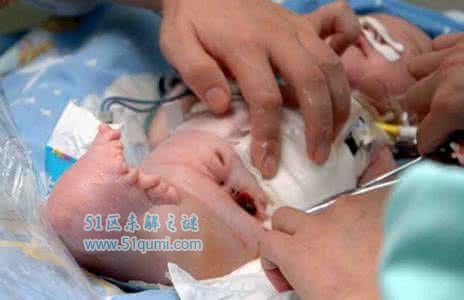 美人鱼综合症病因是什么?中国第一例"美人鱼"仅活38天