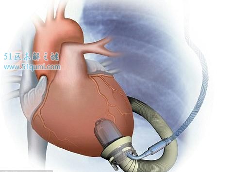 人工心脏可以活多久?换人工心脏需要多少钱?