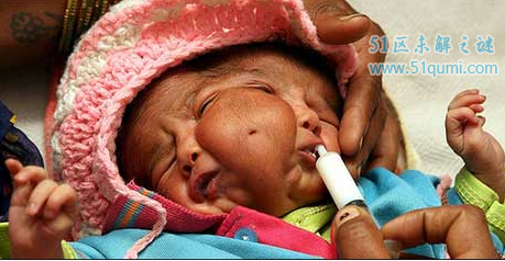 印度双面女婴被当神顶礼膜拜 罕见畸形儿不治离世