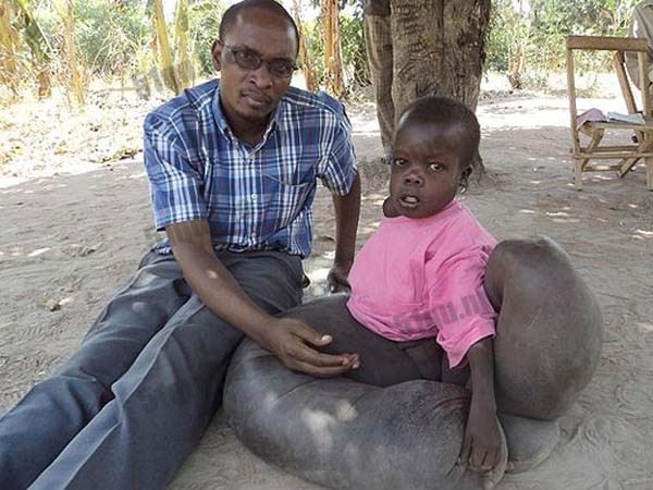 乌干达男孩得怪病双腿异常肿胀宛若大象腿
