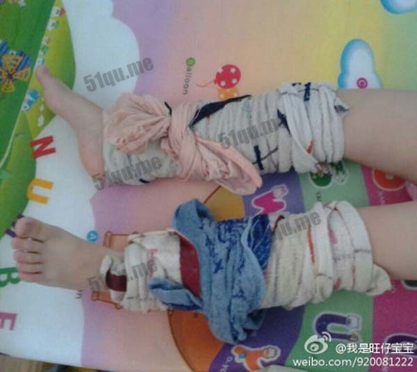 幼儿湿毛巾绑腿退烧法