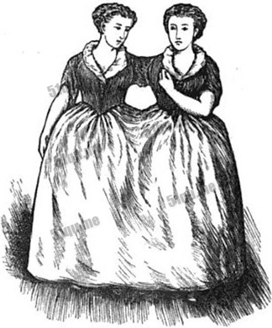 英国 Mary与Eliza Chulkhurst连体姐妹