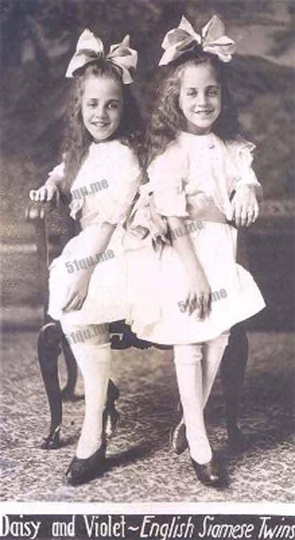 20世纪著名连体双胞胎的故事