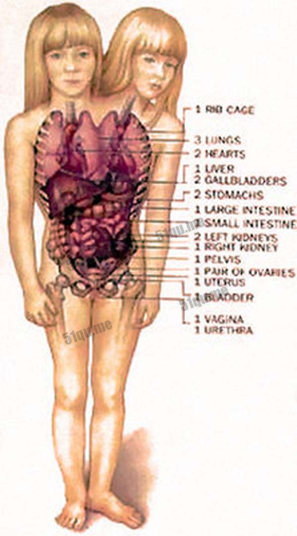 Abigail与Brittany Hensel的身体结构示意图。