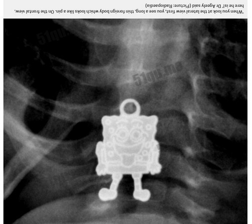 一位小孩的X光片中竟发现让医生当场尖叫的物品。