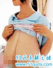 胸大真的好吗?四川女孩巨乳症导致胸部巨大