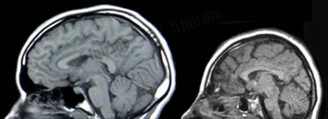 一般人（左）与小头症患者的神经扫描图像比较