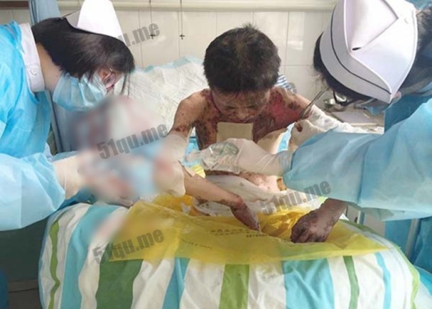 中国妙龄少女患上怪病 罕见的淋巴结疾病全身溃烂